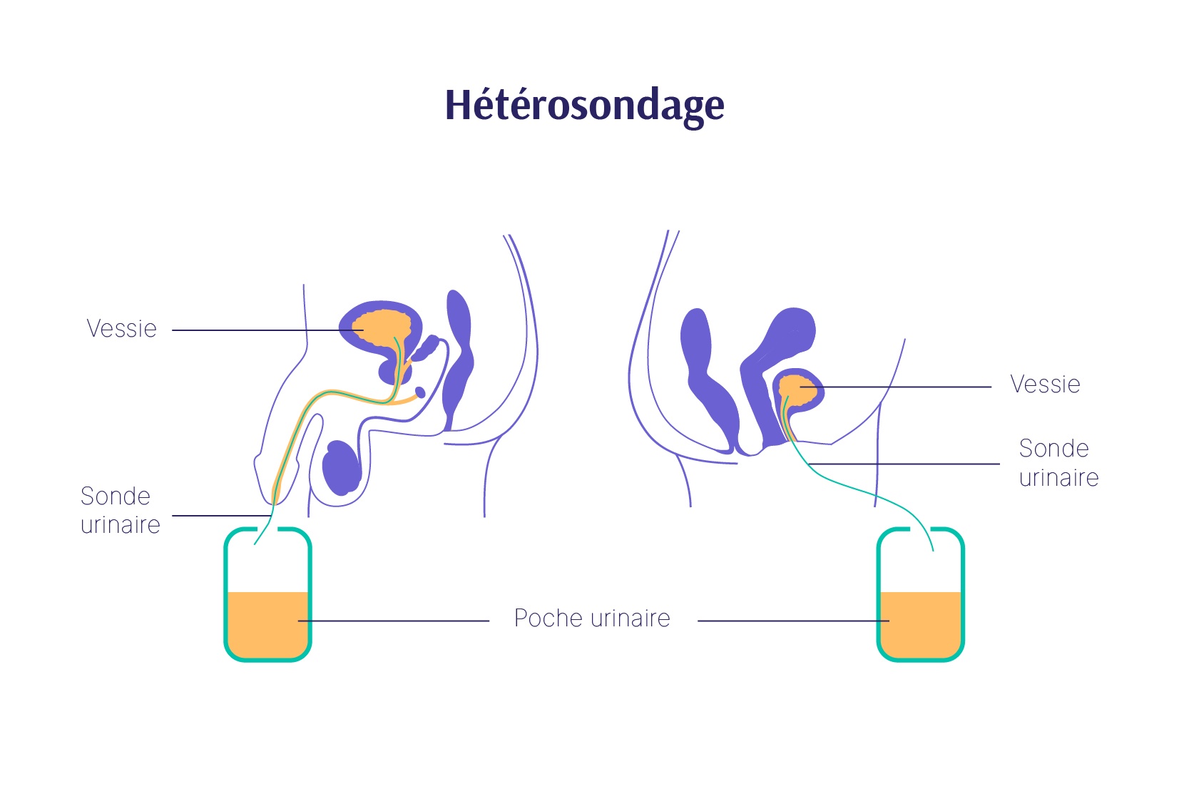 Pratiquer l'auto-sondage intermittent (hommes) - Service d'urologie - HUG