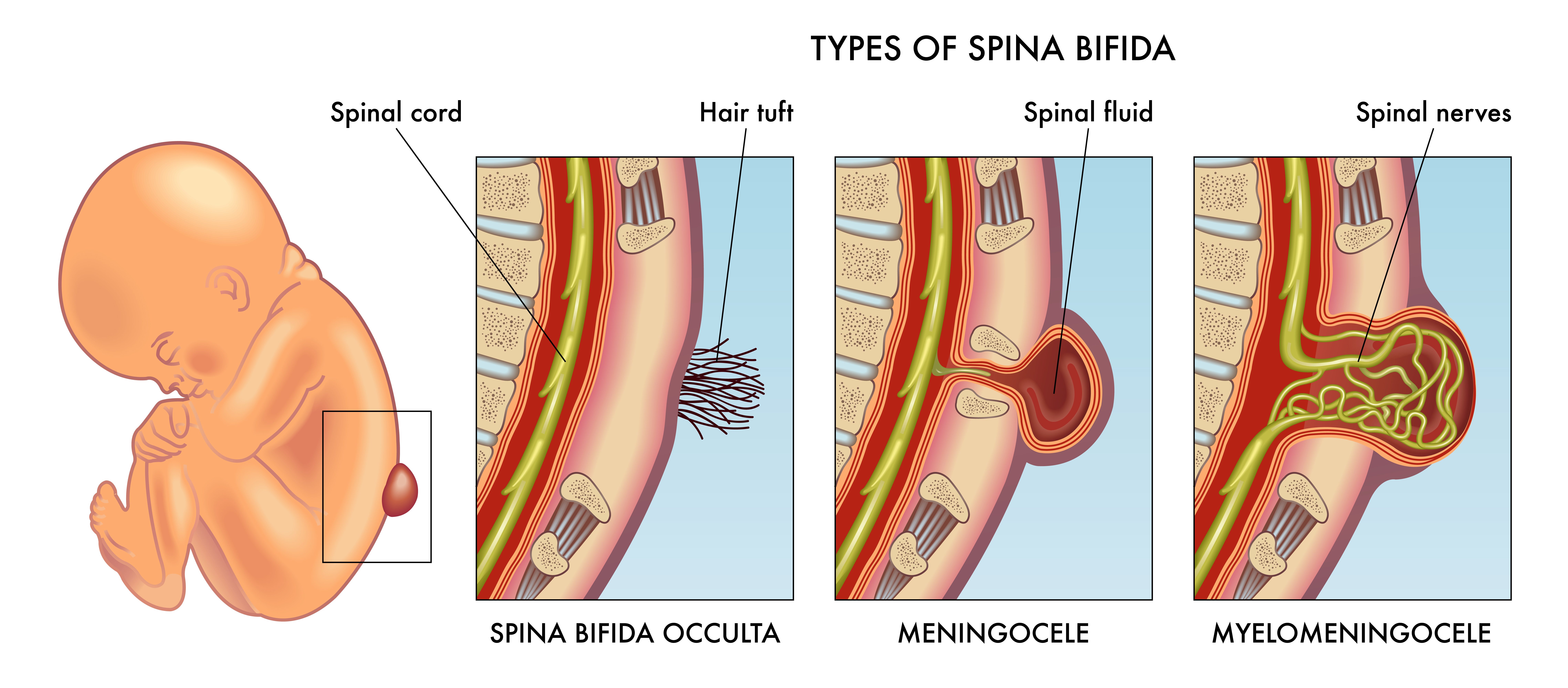 Medical illustration of infant spina bifida with annotation.
